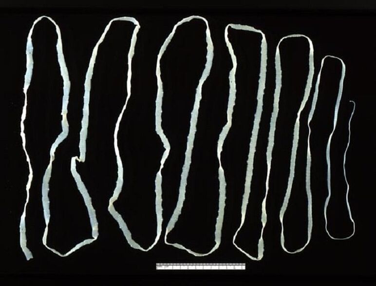 Cacing pita diekstraksi dari usus manusia
